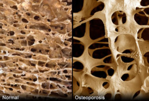 hueso-normal-y-con-osteoporosis